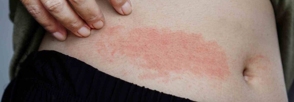 Shingles vaccine in the UK