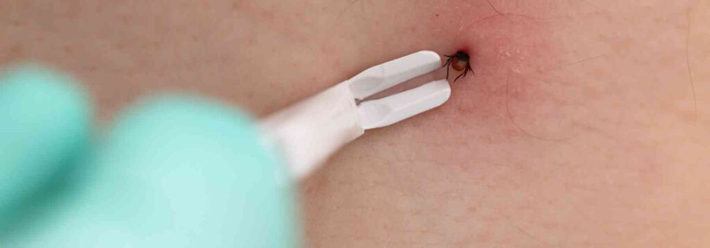 person wearing medical glove using tick removal tool