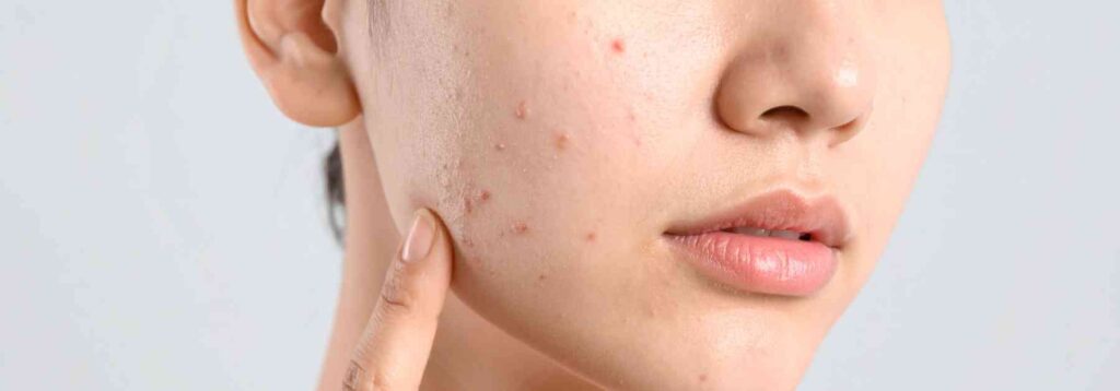 woman pointing to rash on her face